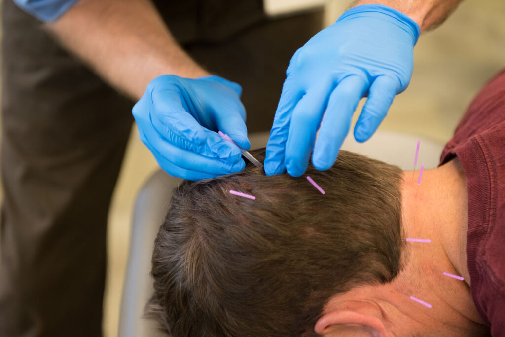 doctor dry needling the back of a mans head in a clinic